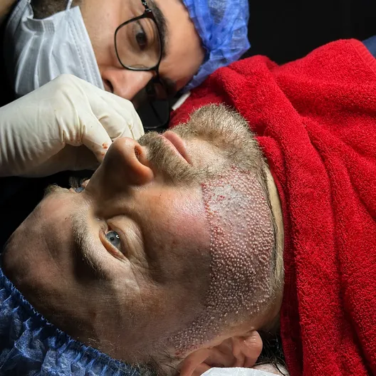 Sakal ekimi sırasında yanak bölgesine yeni yerleştirilmiş greftler